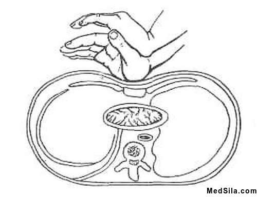 Расположение рук при СЛР